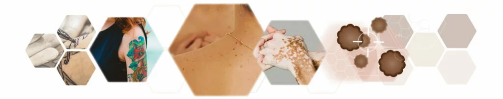 Hautbesonderheiten Fotoset und Melanin-Grafik